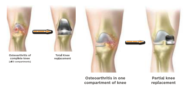 Partial Knee Replacement