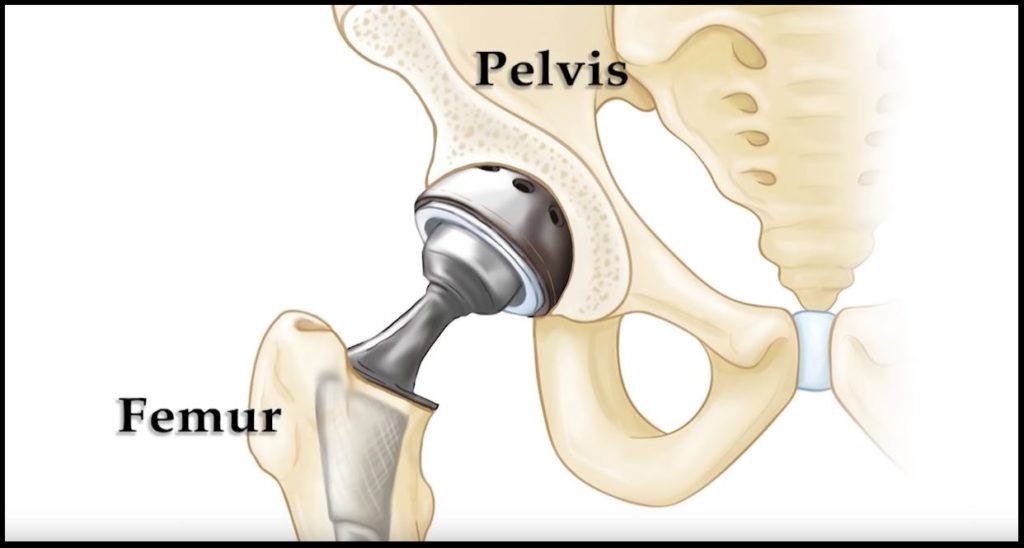 Primary Hip Replacement